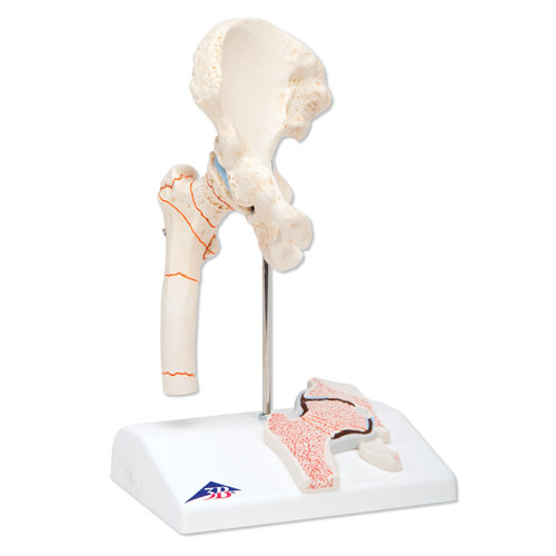 【进口大腿骨折和髋关节炎模型人体骨骼模型骨