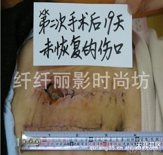 <em>云南永善女子</em>剖腹产 子宫遭切肚皮开裂(附图- 