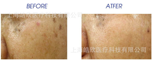 光子嫩肤仪治疗案例3