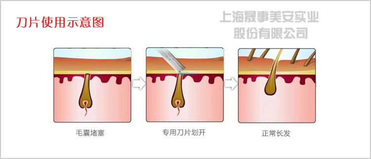 【美国原装PERSONNA74-0001割毛囊(植发)用