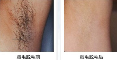脫毛對比圖片