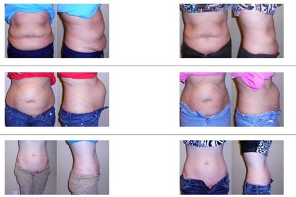 cryolipolysis slimming before