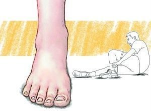 崴脚了!不要热敷要冷敷!