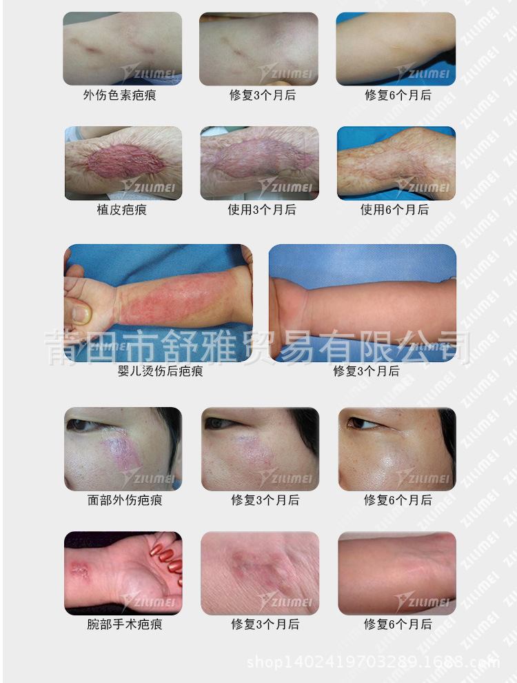 正品韓國Scar Clinic超薄去疤痕貼 燙傷手術剖腹產祛疤痕修復貼