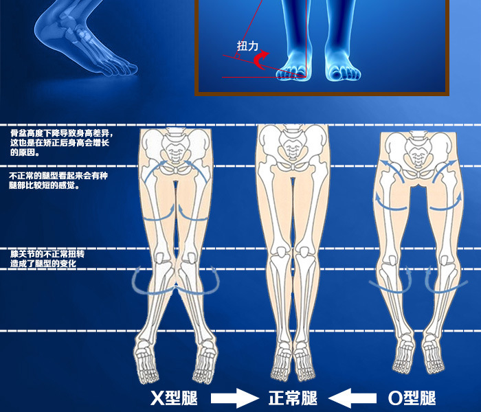 广东广州可裁剪 o型腿鞋垫矫正腿型外八字o型腿矫正
