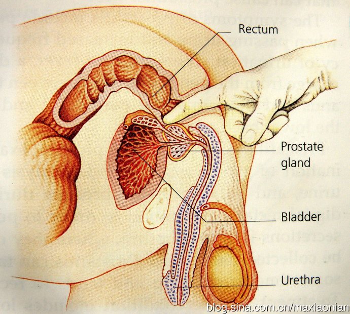 久爱百科 包皮环切术与前列腺癌的关系