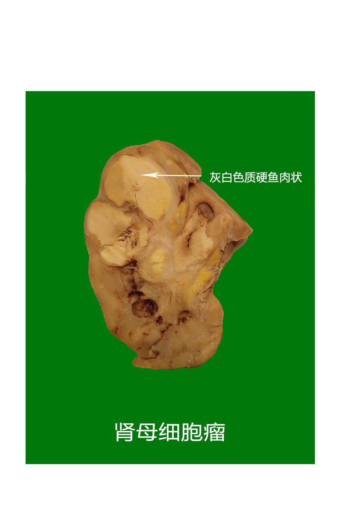 漯河风帆医学 细菌性痢疾病理大体标本