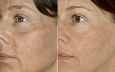 称为"鱼尾纹",它是指微笑时由外眦区域放射而出的皮肤纹理,也称"笑纹"